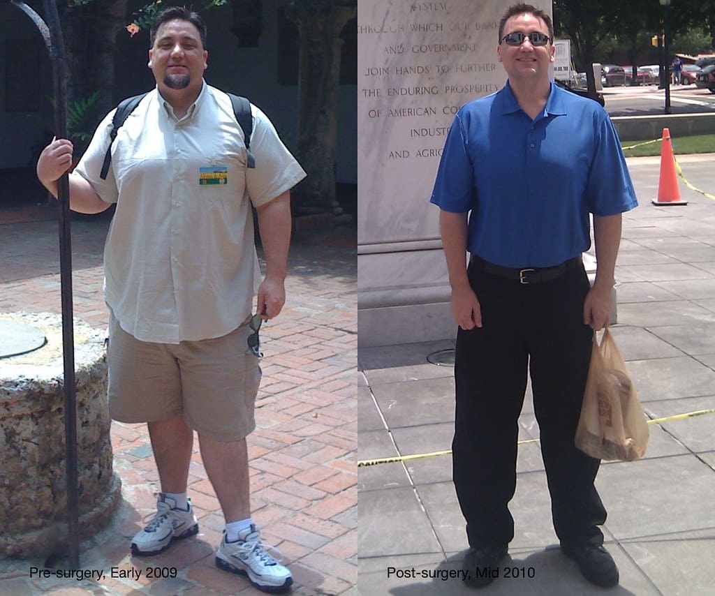 gastric bypass surgery before and after